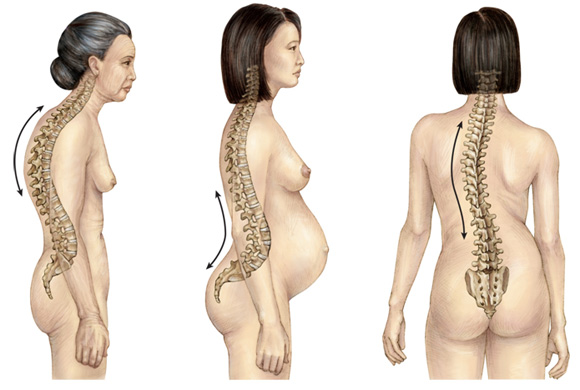 lordosis kyphosis scoliosis