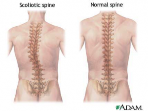 Scoliosis-300x224